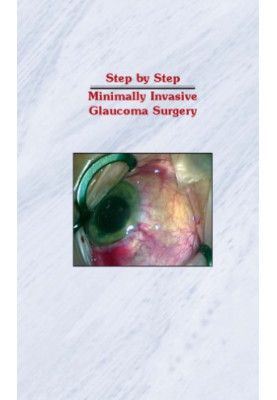 Step by Step Minimally Invasive Glaucoma Surgery