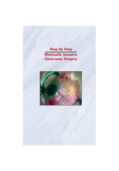 Step by Step Minimally Invasive Glaucoma Surgery