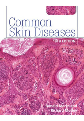 Common Skin Diseases