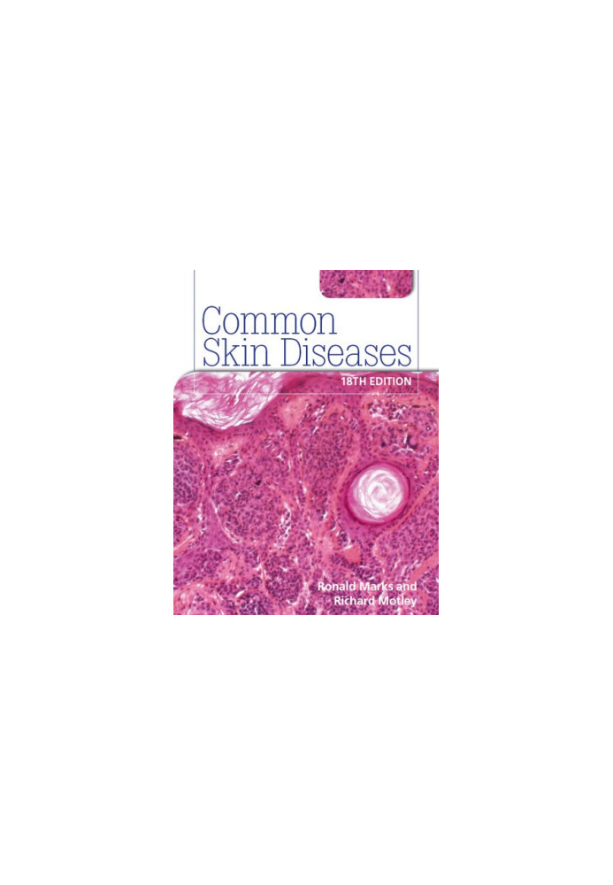 Common Skin Diseases