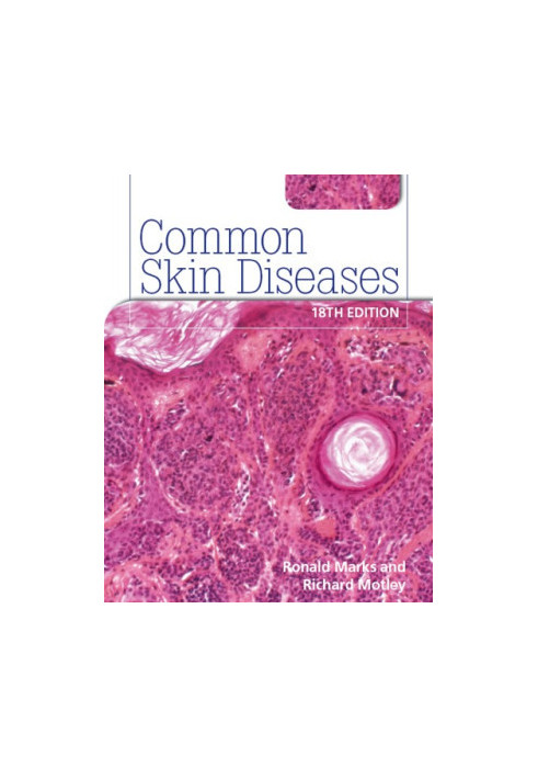 Common Skin Diseases