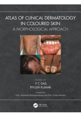 Atlas of Clinical Dermatology in Coloured Skin