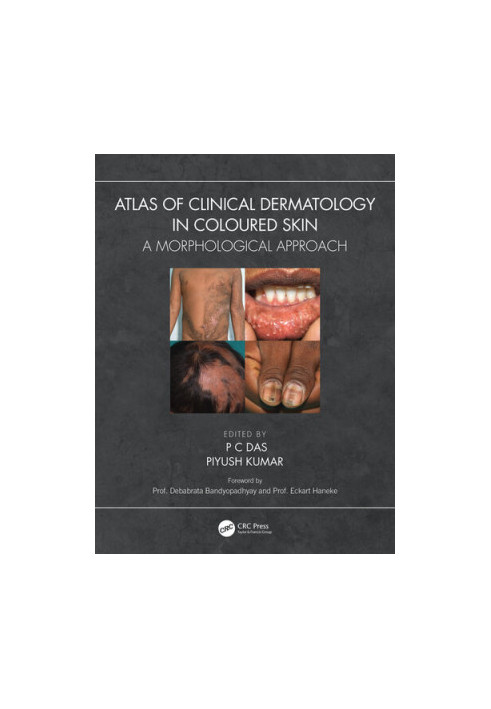 Atlas of Clinical Dermatology in Coloured Skin