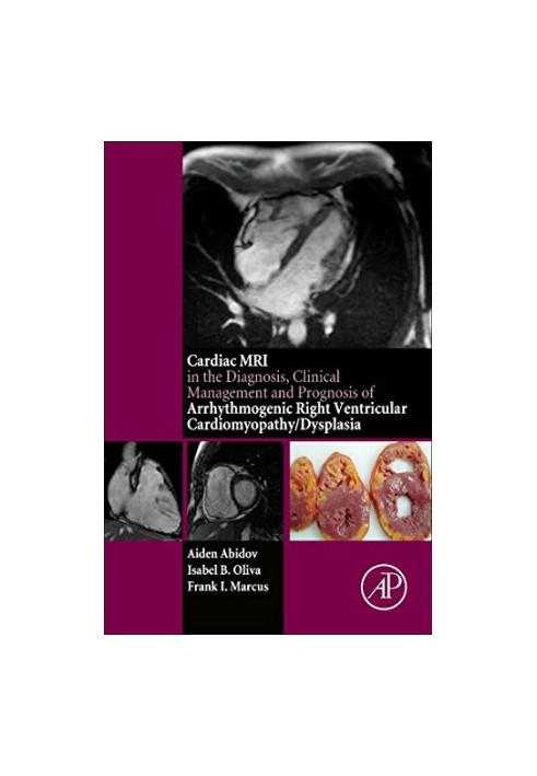 The cardiac MRI in diagnosis, clinical management, and prognosis of arrhythmogenic right ventricular cardiomyopathy/dysplasia