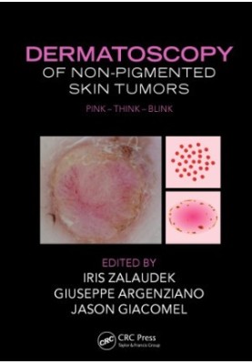 Dermatoscopy of Non-Pigmented Skin Tumors : Pink - Think - Blink.
