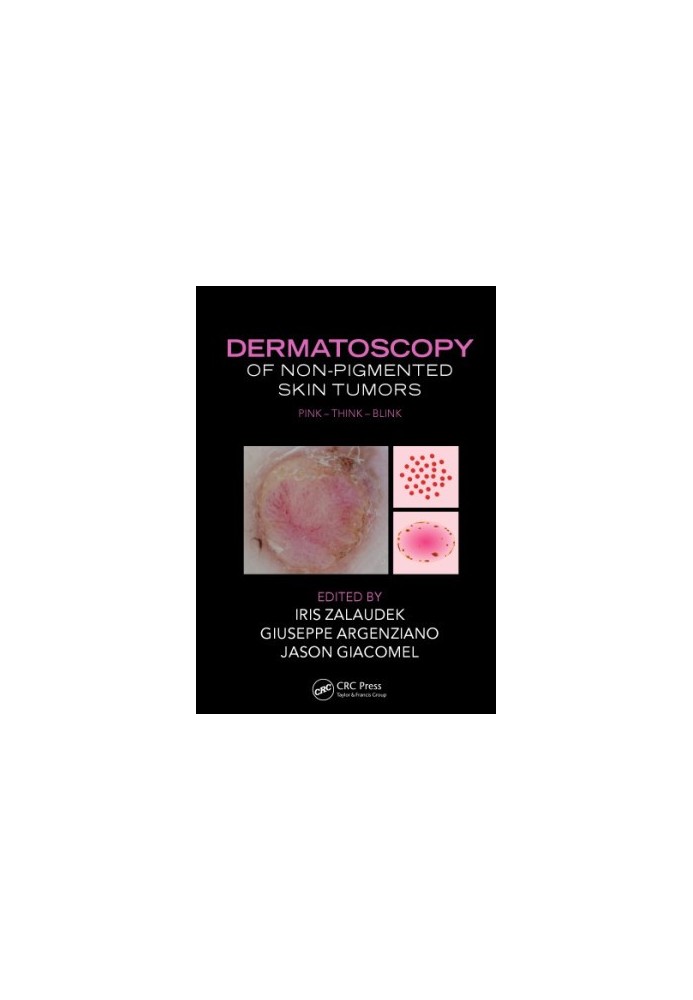 Dermatoscopy of Non-Pigmented Skin Tumors : Pink - Think - Blink.