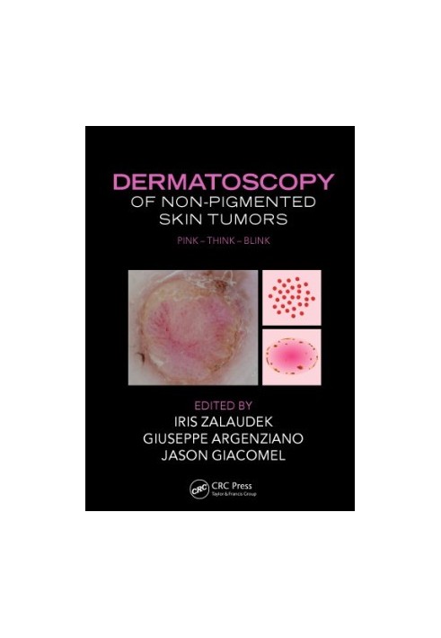 Dermatoscopy of Non-Pigmented Skin Tumors : Pink - Think - Blink.
