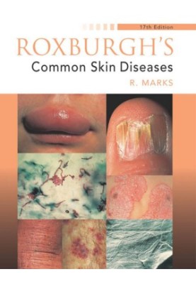 Roxburgh's Common Skin Diseases