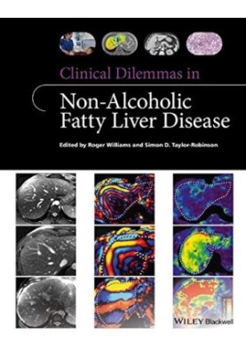Clinical Dilemmas in Non-Alcoholic Fatty Liver Disease (Clinical Dilemmas
