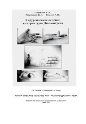 Хирургическое лечение контрактуры Дюпюитрена