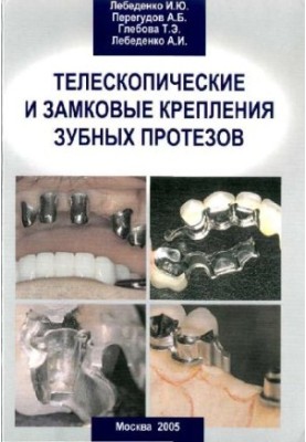 Telescopic and locking attachments of dentures