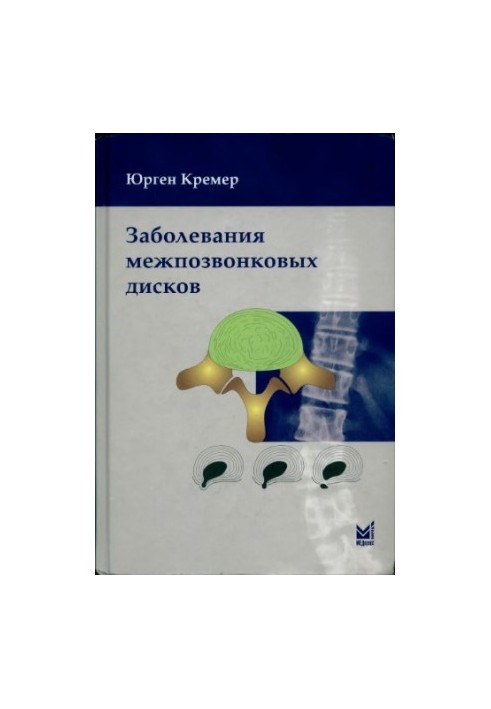 Заболевания межпозвонковых дисков