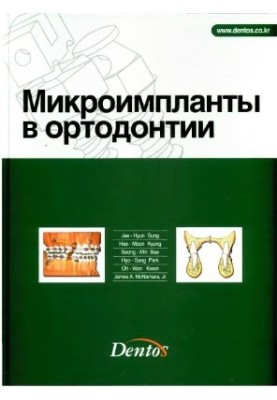 Microimplants in orthodontics