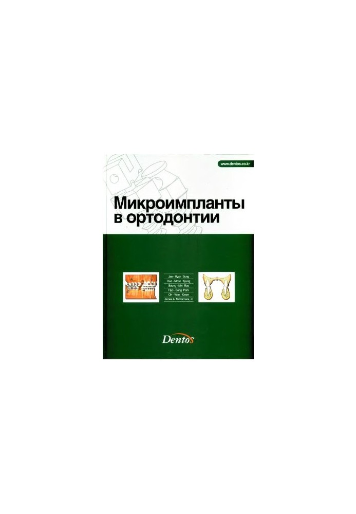 Microimplants in orthodontics