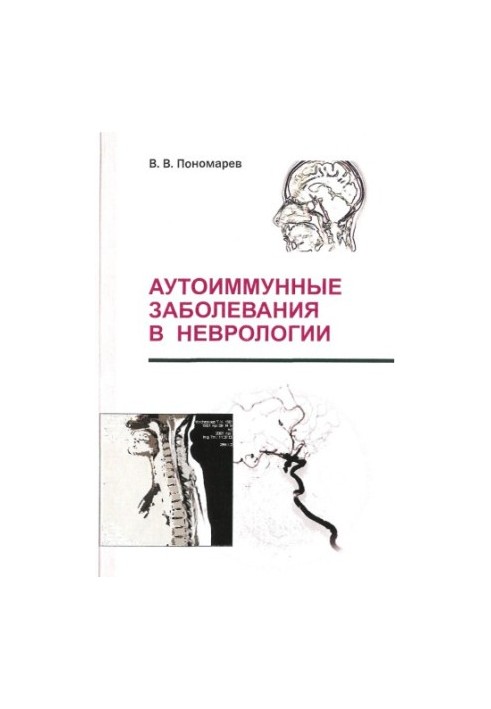 Аутоимунные заболевания в неврологии.